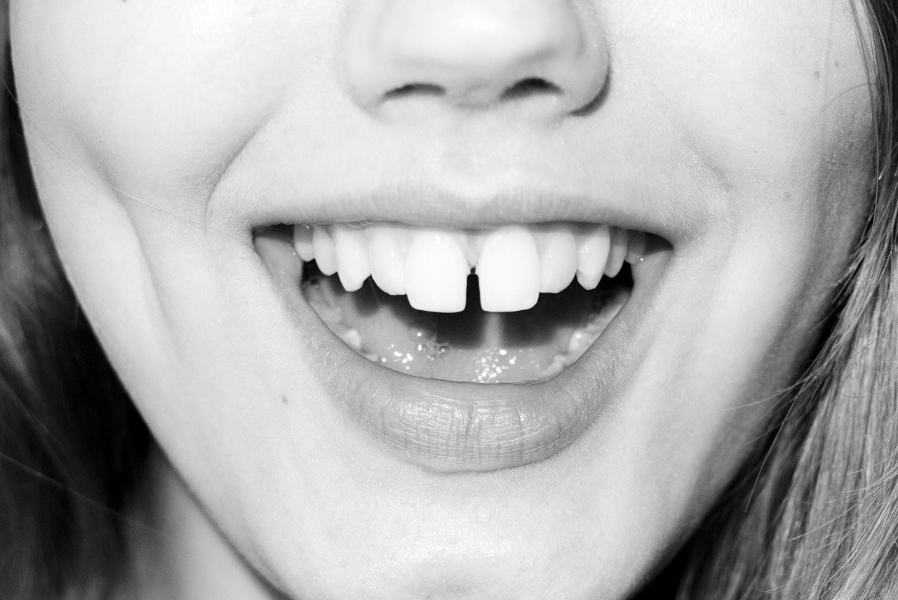 Какое расстояние между зубами. Линдси Виксон зубы.